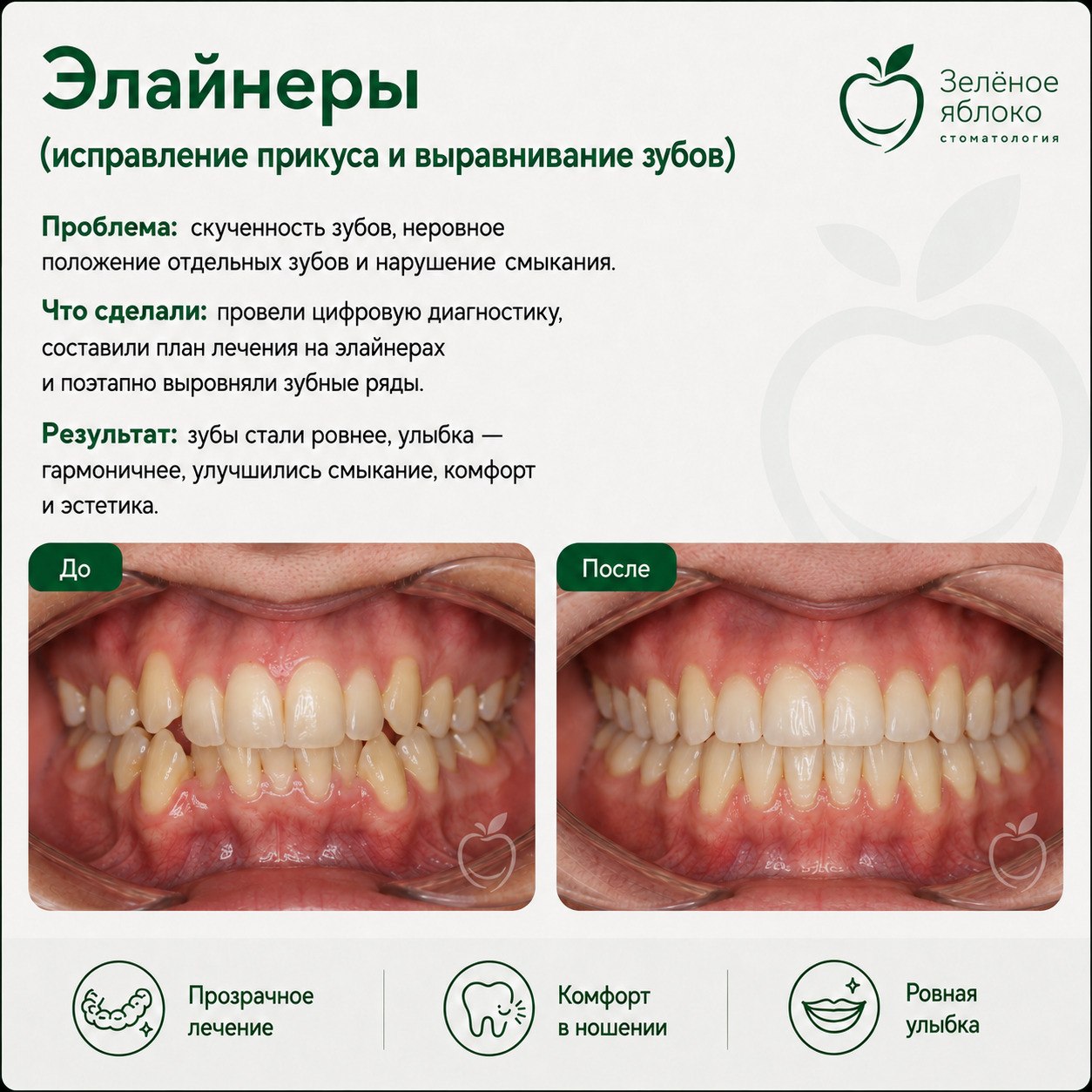 Элайнеры — исправление прикуса