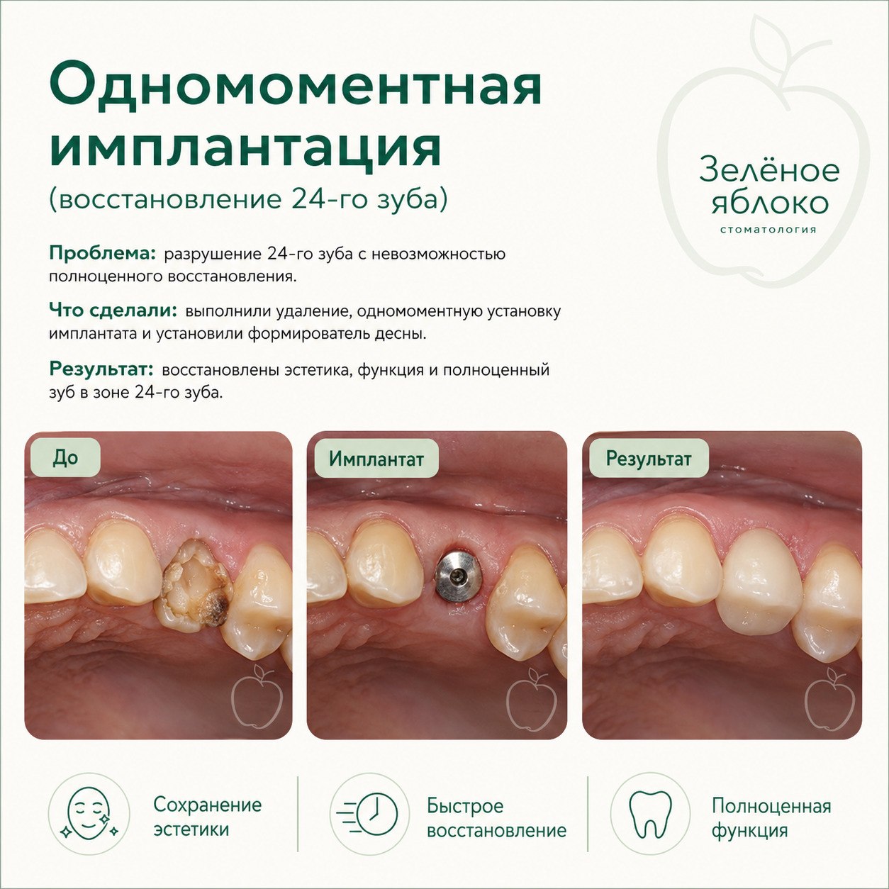 Одномоментная имплантация — восстановление зуба